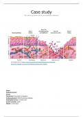 Case Study: Pijn door mucositis bij acute myeloïde leukemie
